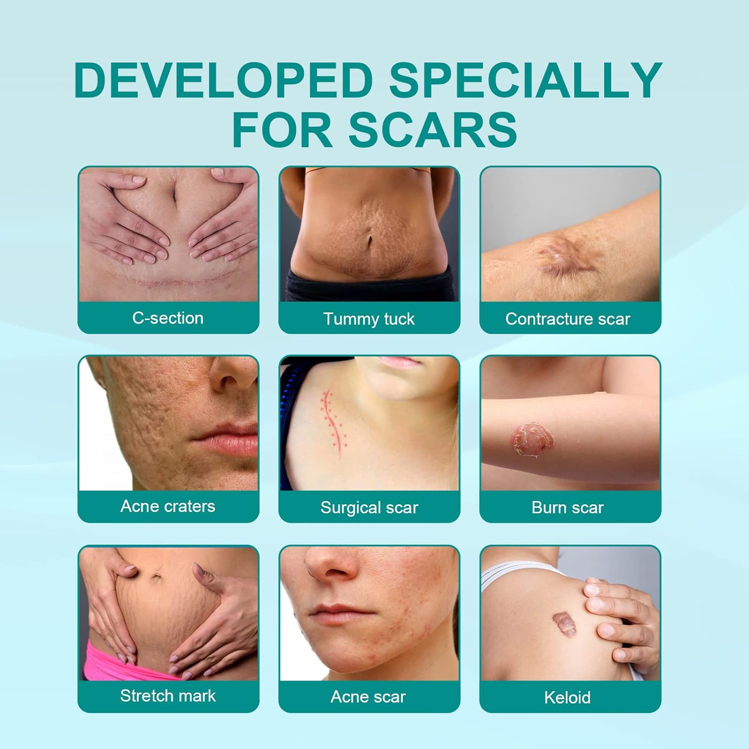 • سبراي طبي لإزالة الندوب - الصورة 2