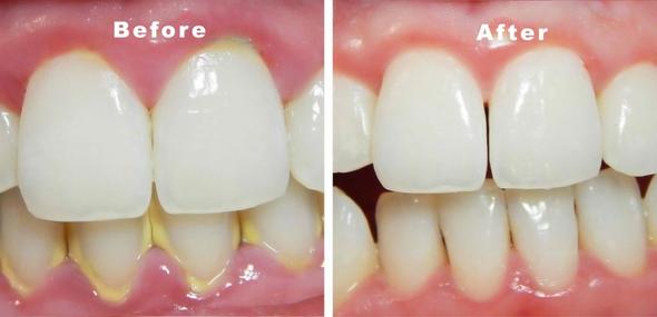 • جهاز تنظيف الاسنان بالالترا ساوند - الصورة 4